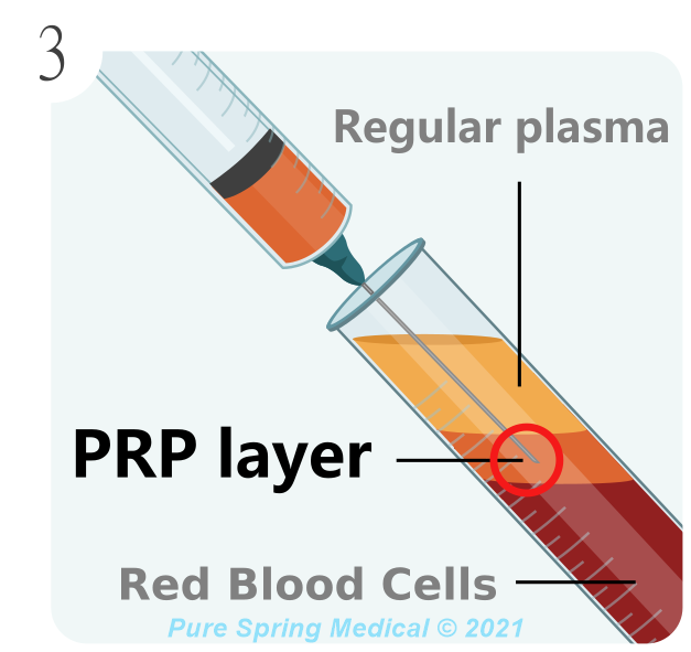 PRP preparation - Step 3